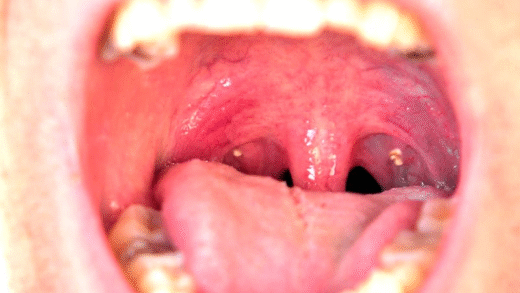 Image showing tonsil stones