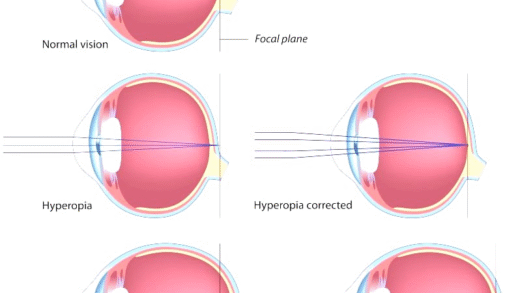 Different types of corrective lenses