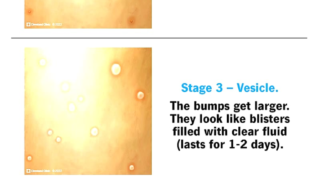Symptoms of Monkeypox Disease